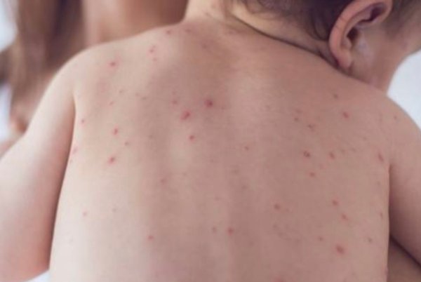 Israel dilanda wabak maut terburuk, catat 5,000 kes dengan 8 kematian